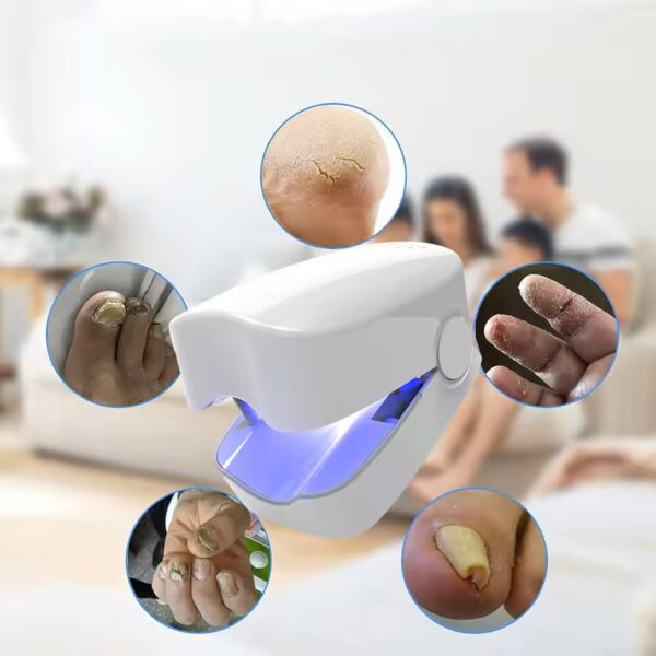 Dispositivo laser antifúngico a funcionar sobre unhas com onicomicose